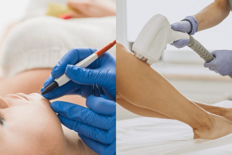 Electrolysis vs. Laser Hair Removal